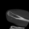 SPORK, NICO - 22.03.1976 - 02.08.2022 - CT obere Extremität - 17:59:38